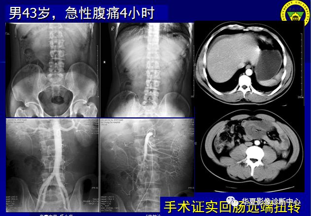 绞窄性肠梗阻图片