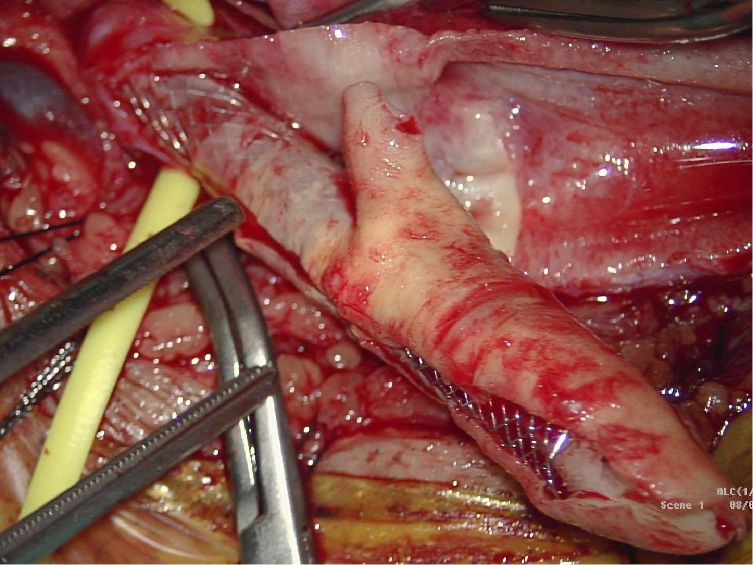 一例放过颈动脉支架后又狭窄的剥脱手术 (原创)