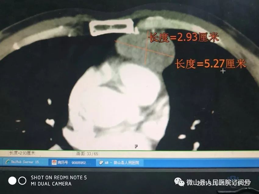 剑突下胸腔镜技术让纵隔肿瘤无处藏身———我院开展第一例经剑突下入路胸腔镜手术-搜狐大视野-搜狐新闻