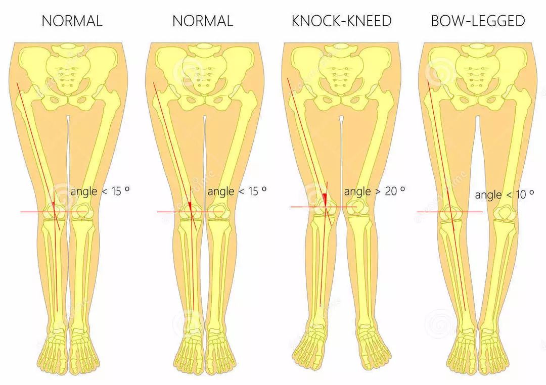 膝外翻导致o型腿 看下面这张图 o型腿的后果就是 "穿裤子不好看" 而且