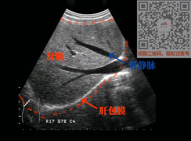 看图首先 我们看看正常肝脏就像下图这样就是把脏器从不同角度切开了