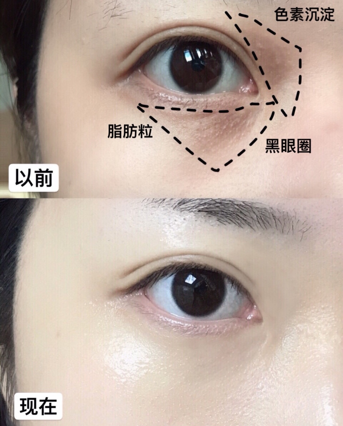 去掉了眼周纹,迎来了脂肪粒?这个锅到底该不该眼霜背?