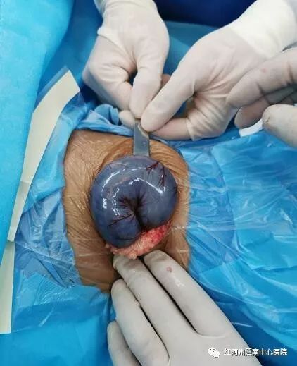 个旧医生妙手为7个月宝宝切除40公分"黑肠子"
