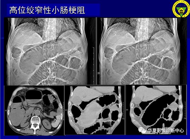 绞窄性肠梗阻图片