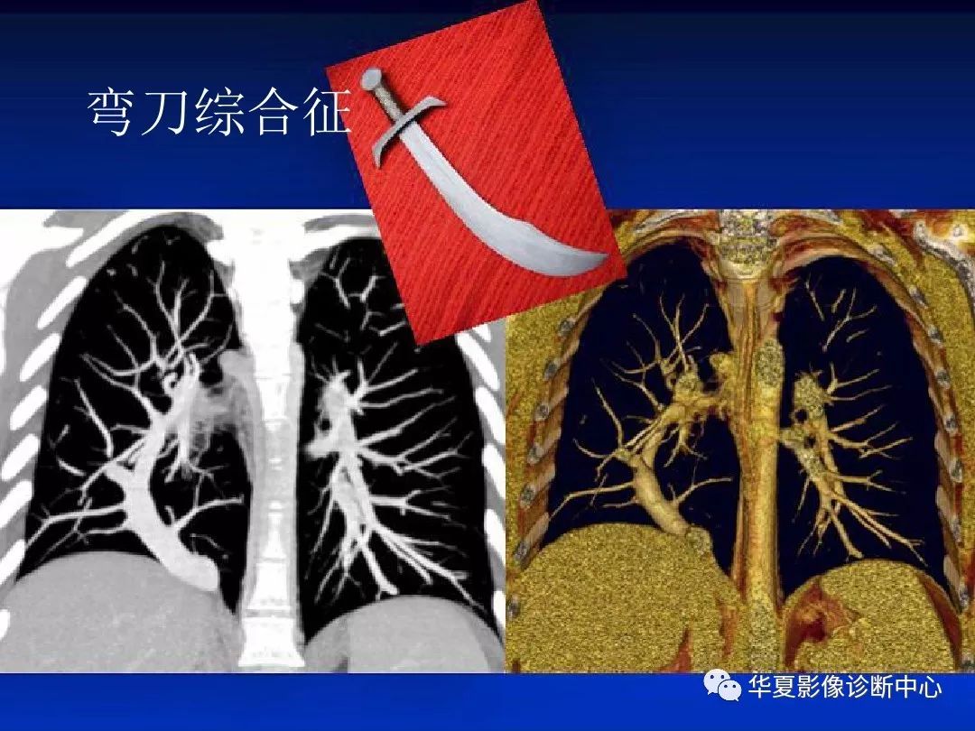 影像基础肺静脉畸形引流的影像诊断