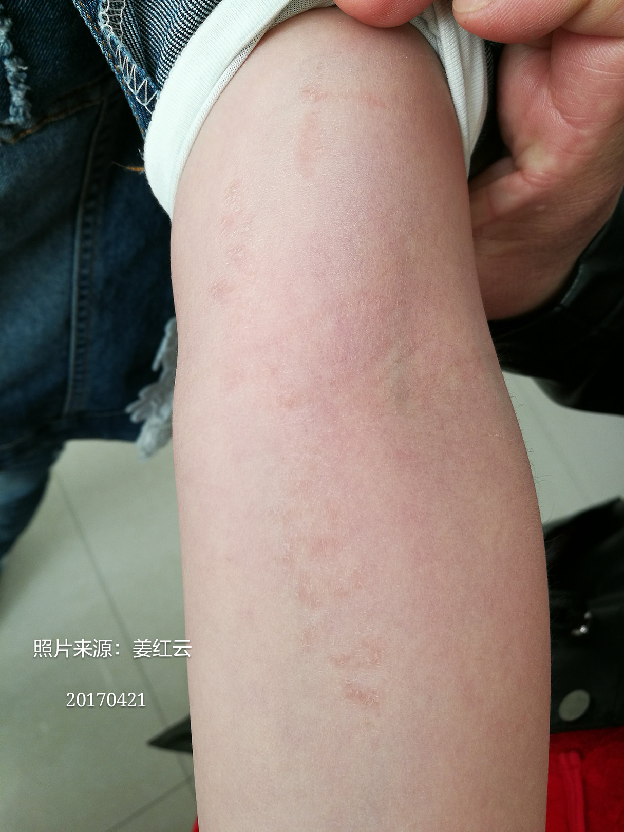 线状苔藓 (原创)_治疗