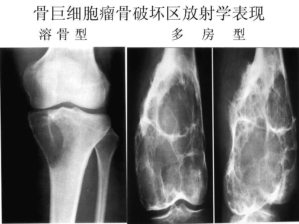 骨巨细胞瘤影像诊断及鉴别诊断 