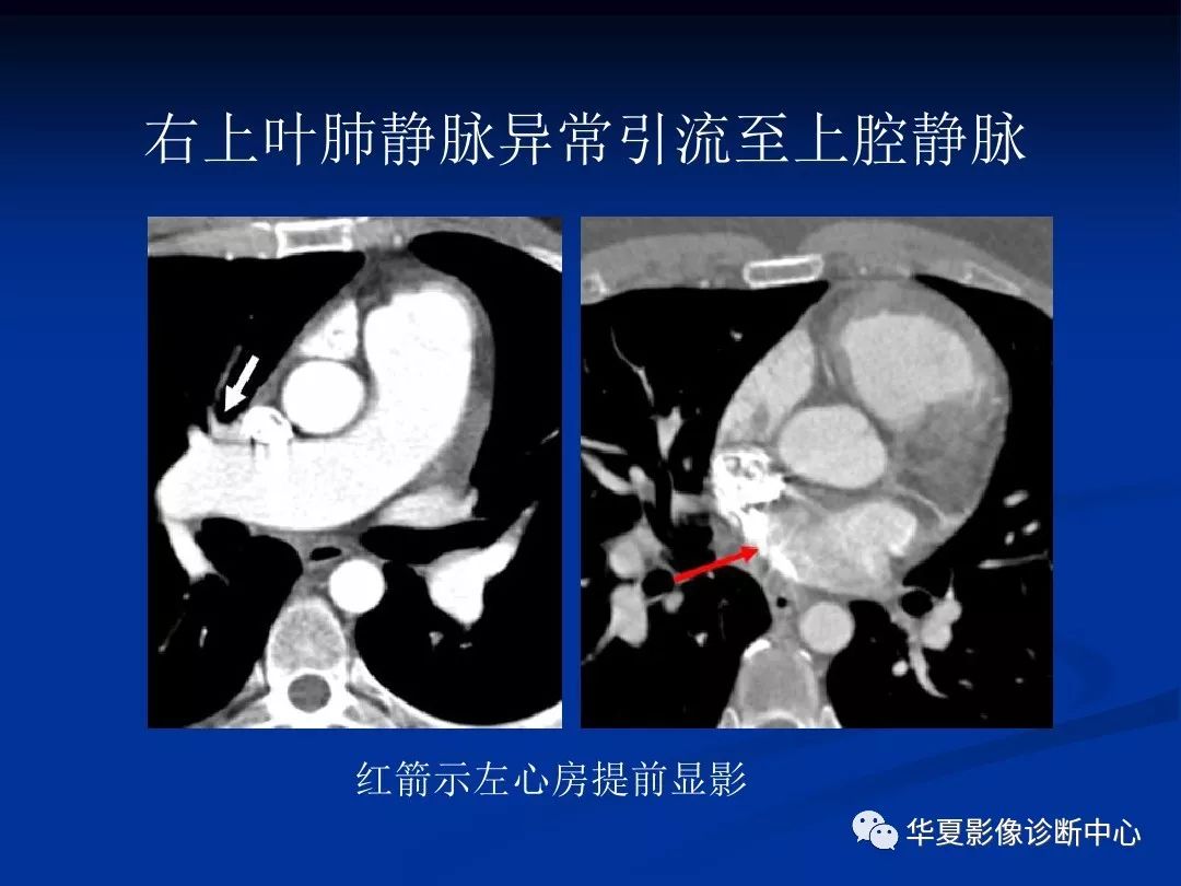 影像基础肺静脉畸形引流的影像诊断