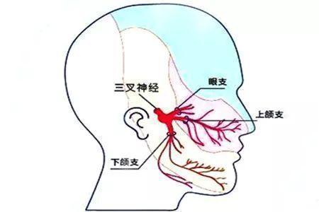 三叉神经痛可找到"扳机点",即触发点,刺激这些点可引起疼痛发作.