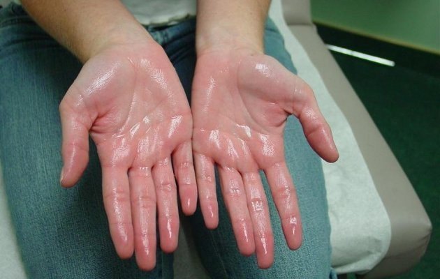 想说爱你不容易手汗症的困惑原创