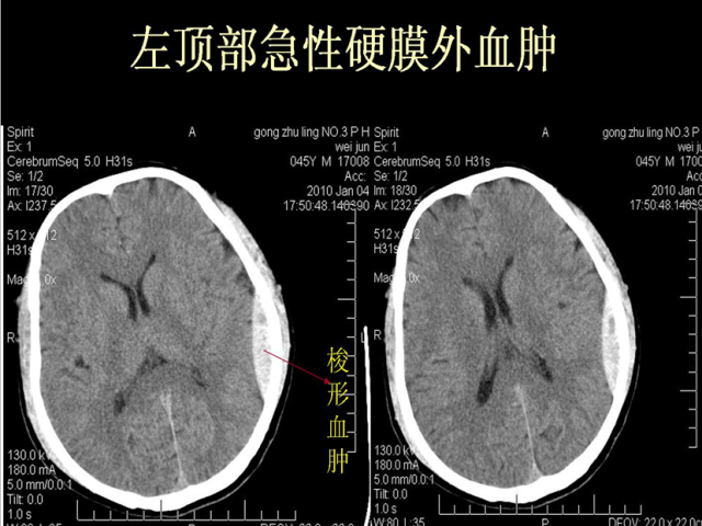 梭形血肿图片