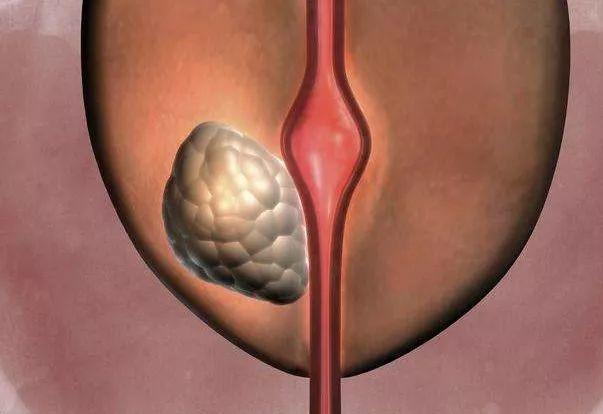 研究称体脂分布或与恶性前列腺癌有关,预防前列腺癌需要注意啥?