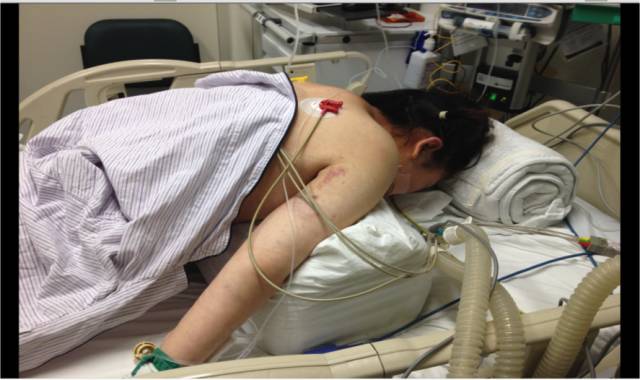 危重患者如何实施俯卧位通气?保证你能学会!