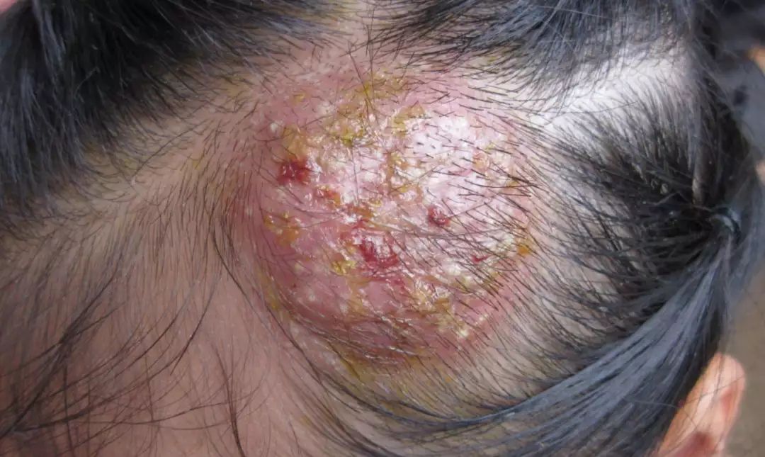 因为养了只宠物兔,却不料感染了兔子身上的真菌,导致整个头皮溃烂流脓