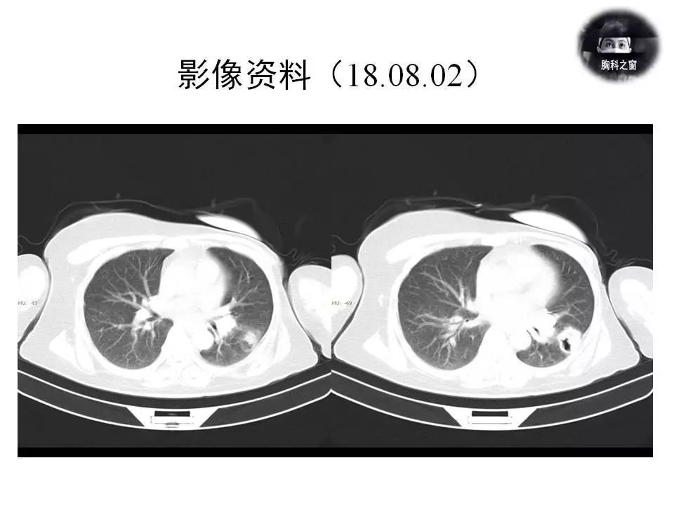 12 ug/ml ↑彩超:肝囊腫,膽囊壁毛糙,脾臟,胰腺未見異常.