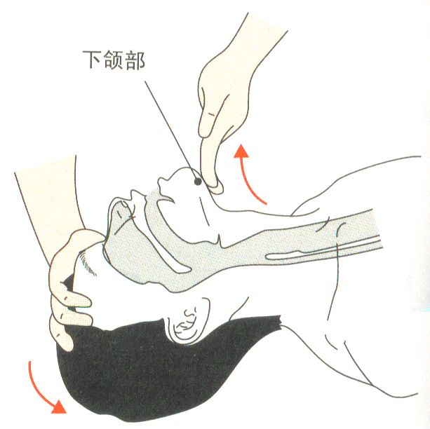 a:开放气道(airway)立即清理口鼻污物,给予传统的abc心肺复苏急救顺序