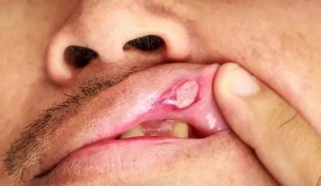 下嘴唇癌早期症状图片图片