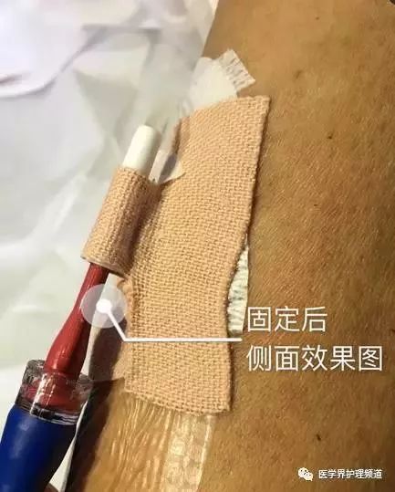 气管插管胶布固定图片