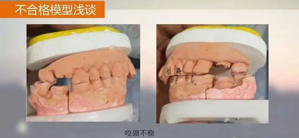 固定义齿的返工分析及处理方案