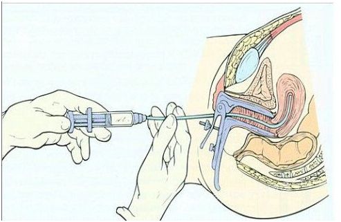 新疗法宫腔灌注治疗