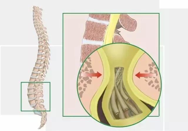 腰椎管狭窄走不远路该怎么办原创