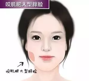 第二种:咬肌肥大第一种:面部脂肪堆积特别提醒大家:脸大可不是单纯靠
