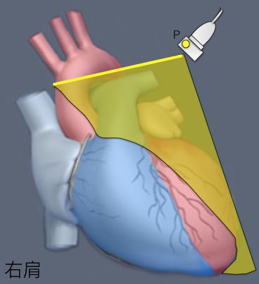 二尖瓣,主动脉瓣局中,纵切升主动脉,未见心尖部横向运动.
