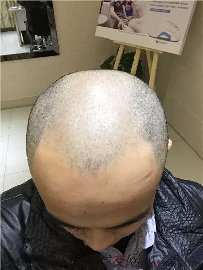 长沙润琪植发(薇琳植发是正规医院吗)
