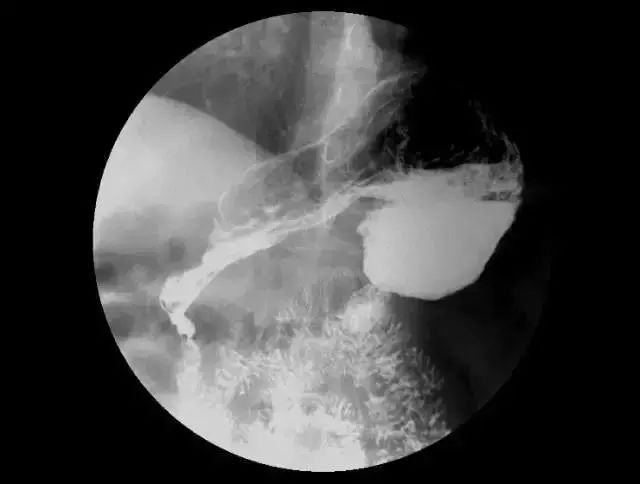 胃穿孔x光图片图片