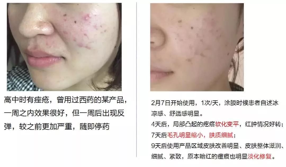 丹芎瘢痕涂膜生活不留疤 岁月不留痕