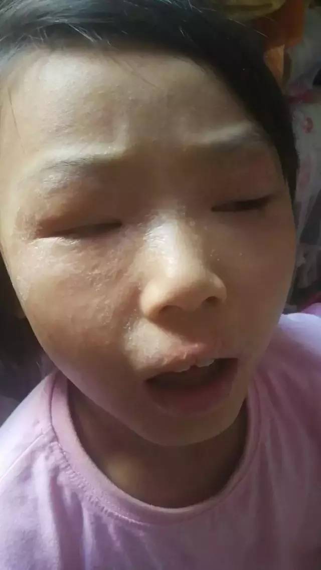 医疗无望的特应性皮炎的康复之路