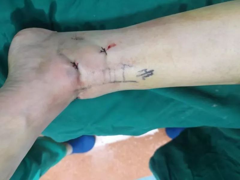 运城市首例踝关节镜下踝关节融合术