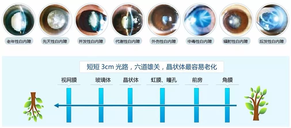 白-白内障白内障是与年龄相关的疾病,居我国致盲因素之首,75岁以上