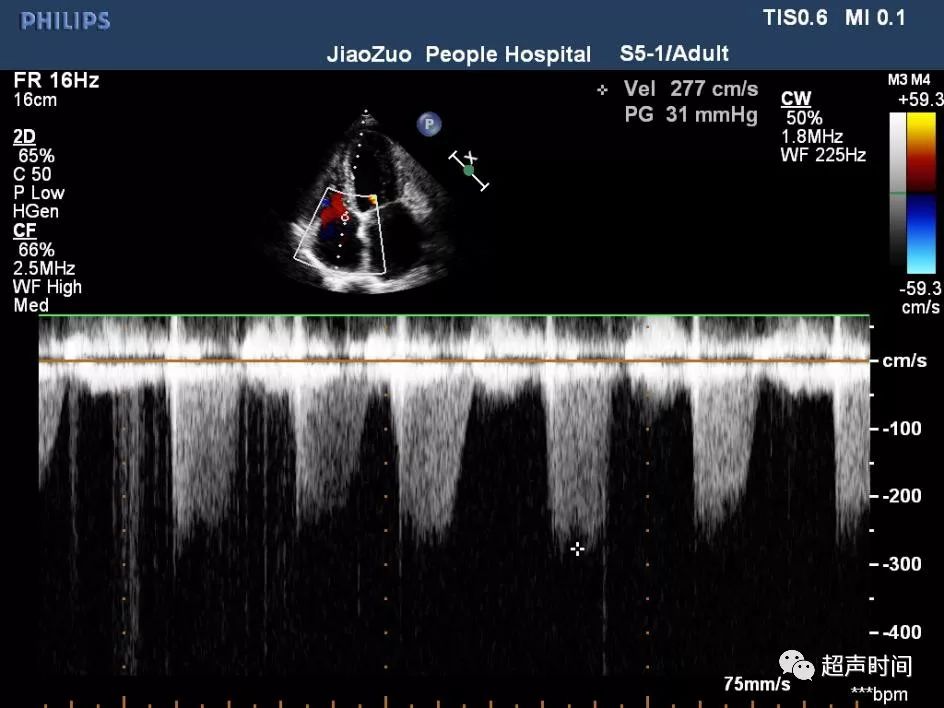 因反流速度不等,需测量连续 3~5 个心动周期,取其平均值超声诊断要点