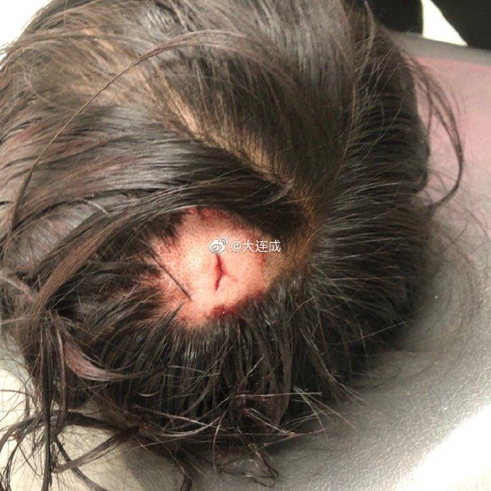 大连11岁女孩玩捉迷藏被砖头砸伤 家属寻找目击者