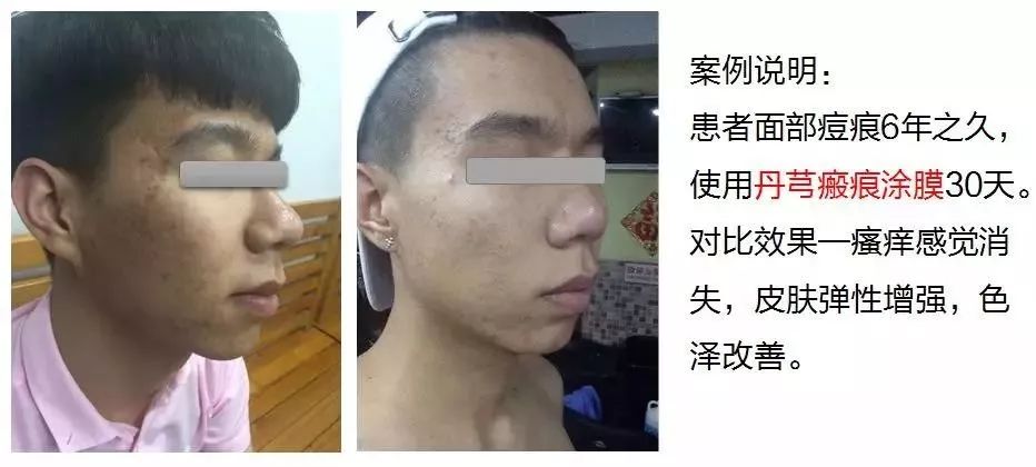 丹芎瘢痕涂膜生活不留疤 岁月不留痕