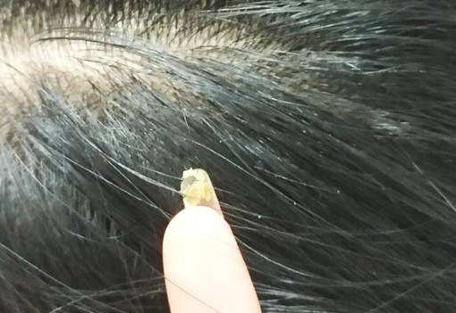 头螨一经发现数量就已破千万,多少人发根遭螨虫蚕食,2招来帮你_头皮