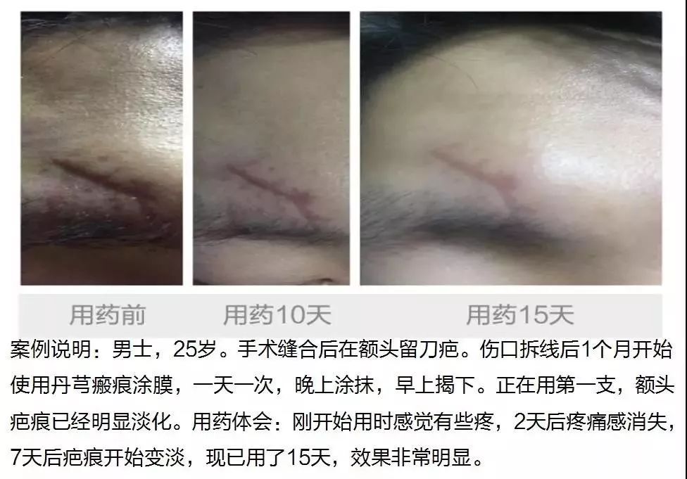 丹芎瘢痕涂膜生活不留疤 岁月不留痕