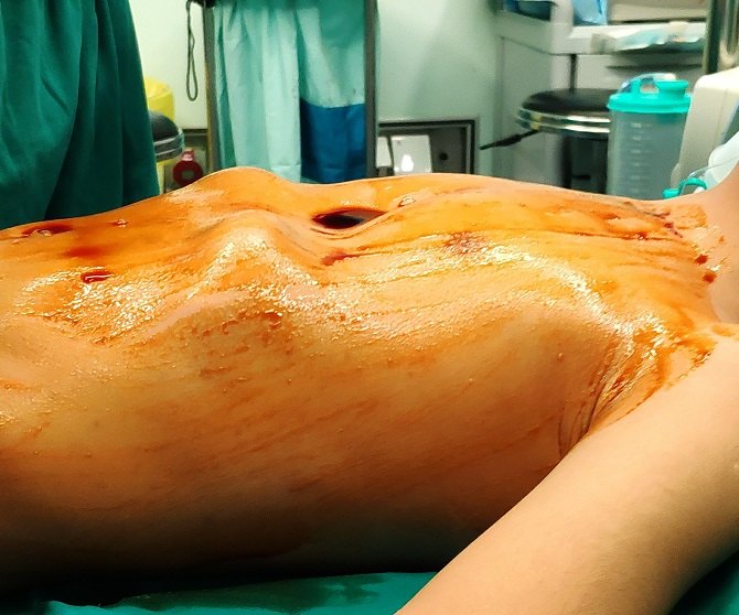 在省妇幼完成的两台wang手术 (原创)