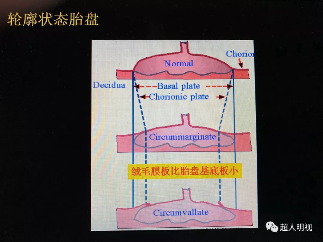 轮廓胎盘