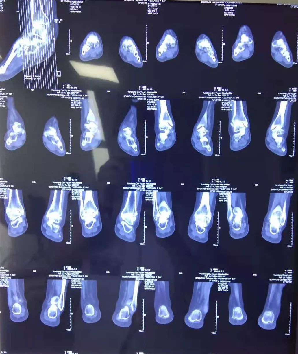 运城市首例踝关节镜下踝关节融合术