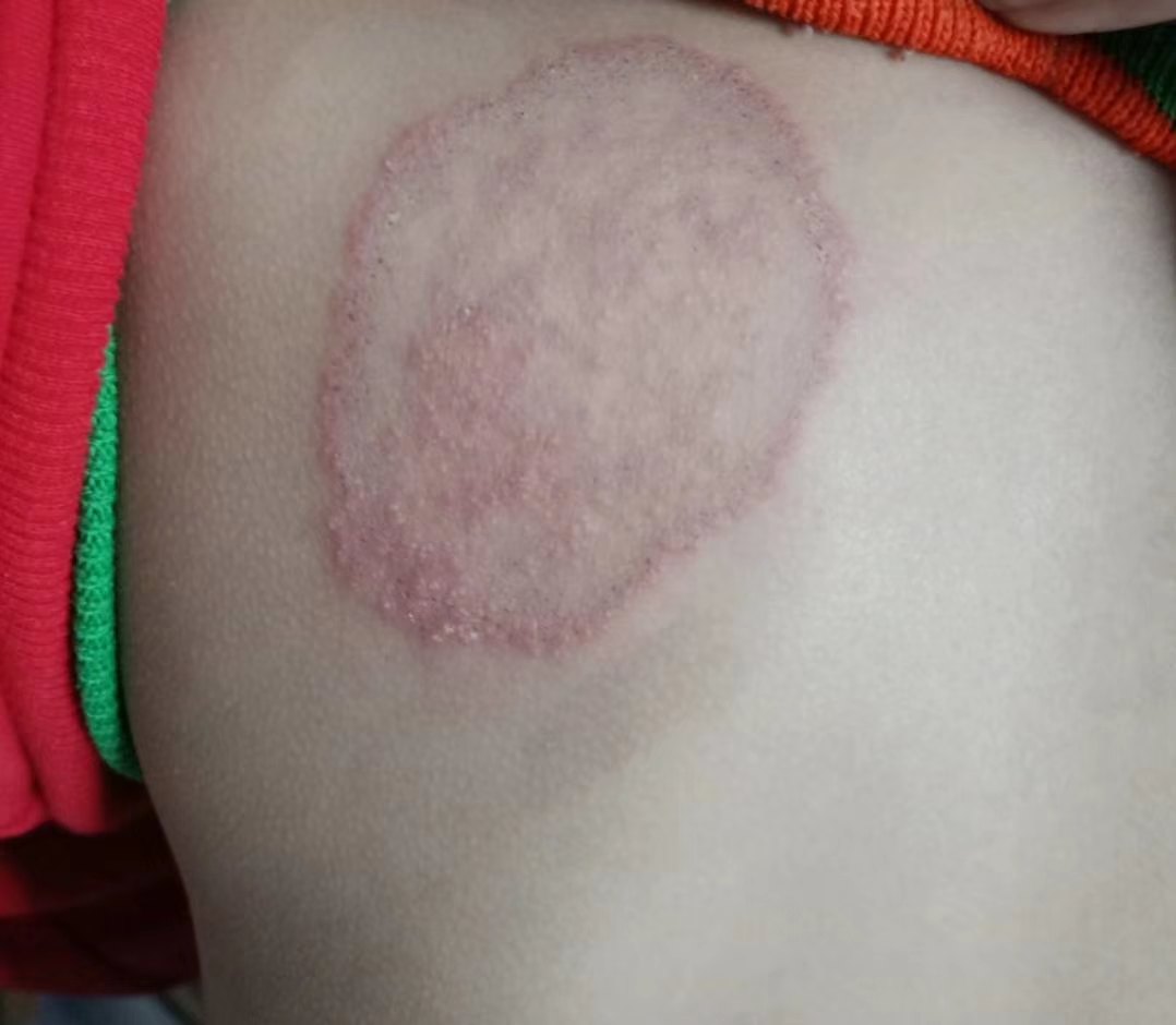 病例分享 (原创)_体癣