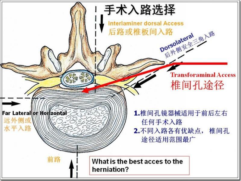 椎管狭窄手术图解图片