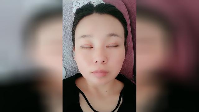 失败双眼皮,非常不满意,眼睛闭不上!