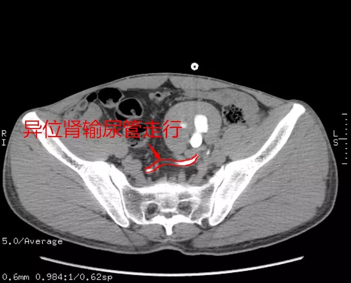 可合併膀胱輸尿管反流或腎盂輸尿管連接部梗阻,易併發腎積水,感染和