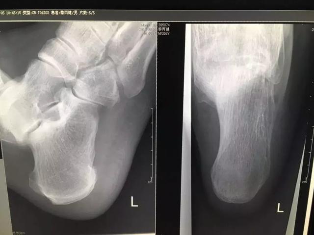 (跟骨骨刺的x片)疼痛科门诊孙燕羽冲击波治疗过程:5