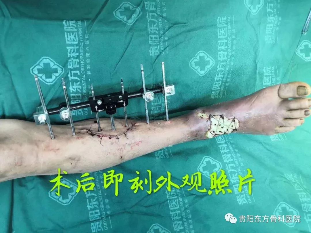 【贵阳晚报】扭伤包草药 男子险截肢