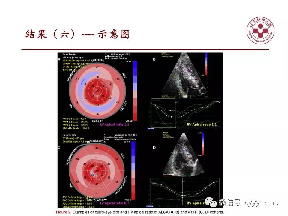 rv ar可能是斑点追踪超声心动图鉴别淀粉样变亚型的一个参数.