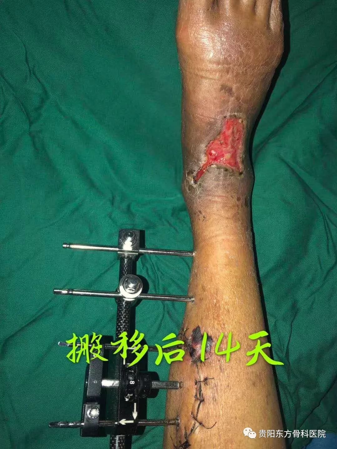 【贵阳晚报】扭伤包草药 男子险截肢