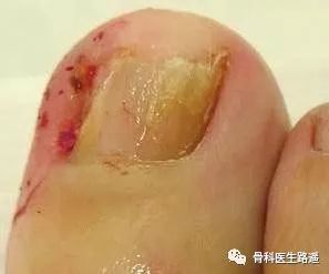 脚趾甲总往肉里长得了嵌甲怎么办